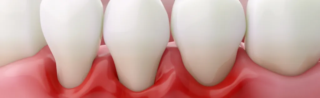 歯周病の歯