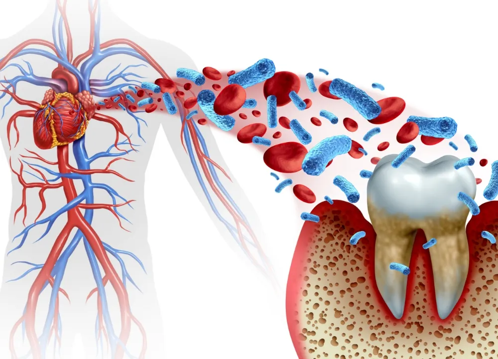 歯周病が全身疾患に関係する