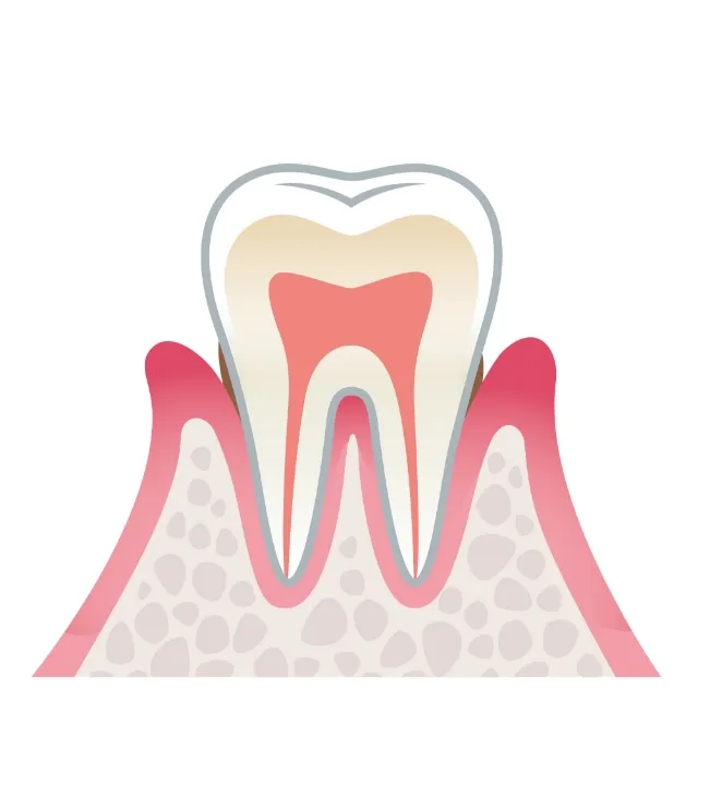 歯周炎(軽度)の状態