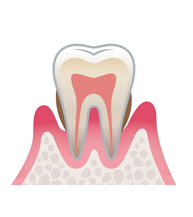 歯周炎(中度)の状態