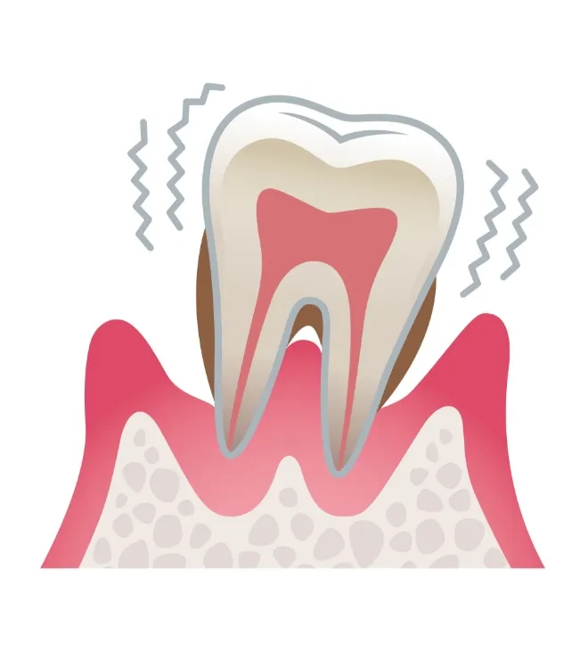 歯周炎(重度)の状態