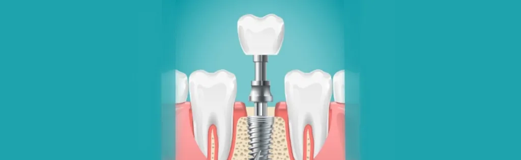 インプラント治療とは