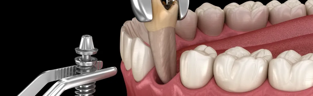 抜歯即時・即時荷重