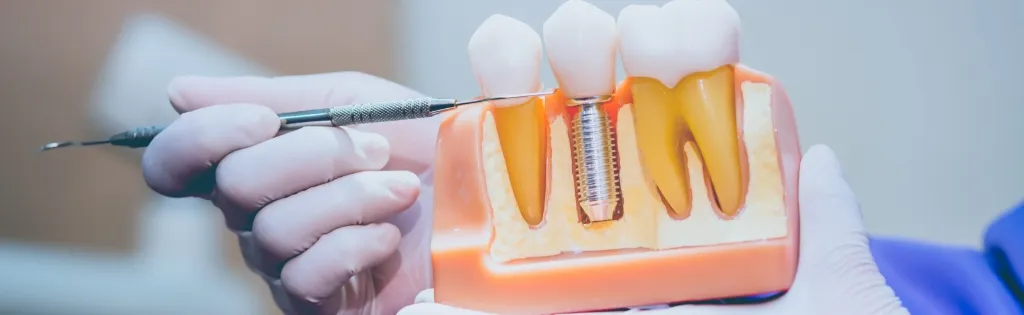 当院のインプラント治療の特徴