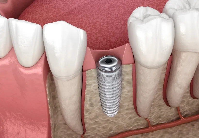 インプラントの埋入