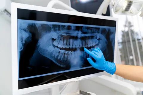 パノラマX線装置